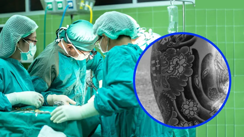 Un médico extirpó parte del intestino de su paciente tras CONFUNDIR TATUAJE con un tumor