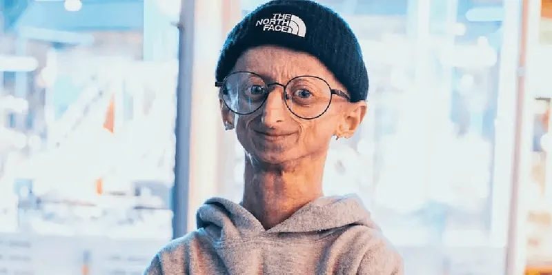 Michiel Vandeweert muere a los 28 años tras desafiar la progeria