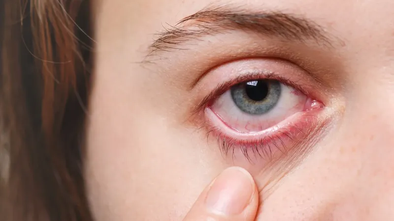 Pantallas y aire acondicionado: la combinación del verano que dispara el ojo seco