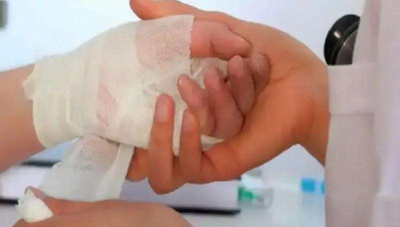 Más de 100 médicos se capacitan en quemaduras en Managua