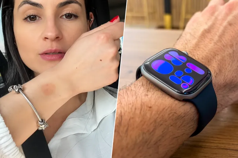 Llevamos el Apple Watch tantas horas que ya hay un nombre para el problema que puede provocar en la piel: "watch rot"