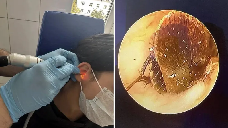 Acude a urgencias por un dolor en el oído y le encuentran una cucaracha