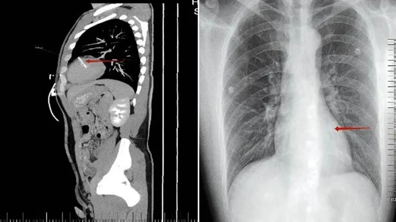 Acude al hospital por un dolor al orinar y los médicos encuentran algo inquietante en su cuerpo